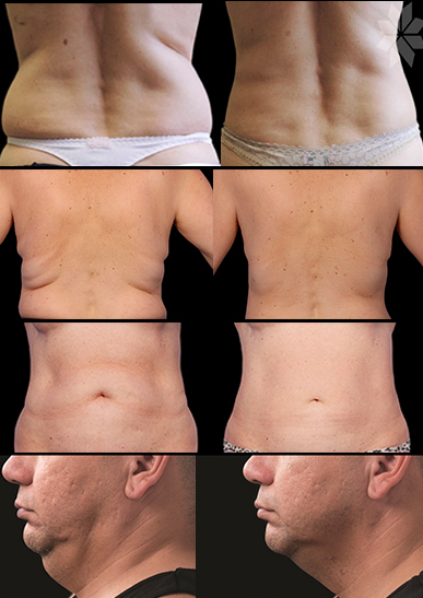 CoolSculpting-real results2
