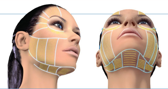 Ultherapy full face and neck Fort Lauderdale FL-1