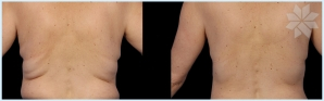 coolsculpting-before-and-after-11.jpg