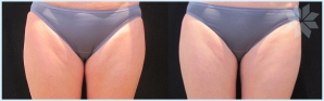 coolsculpting-before-and-after-2.jpg