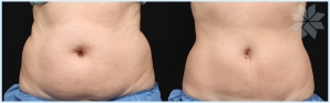 coolsculpting-before-and-after-7.jpg