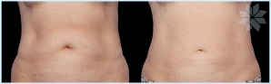 coolsculpting-before-and-after-9.jpg