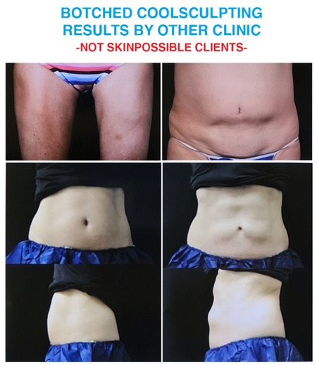 burched coolsculpting results