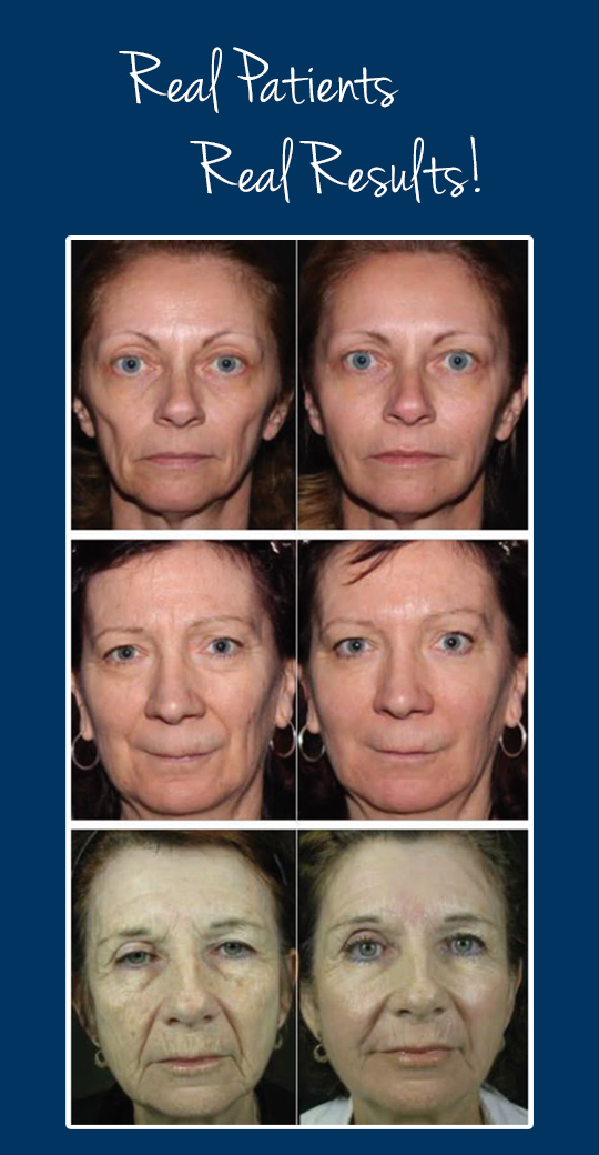 before and after cosmetic injections results dr.cyr.calgary