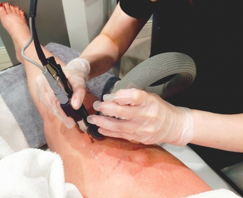 laser-vein-therapy-calgary
