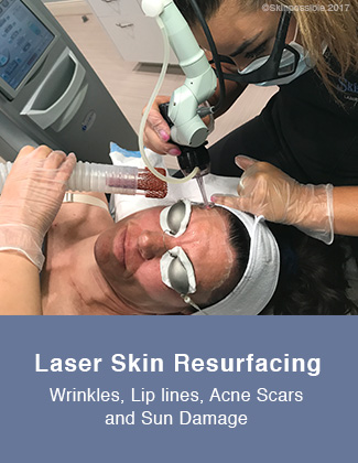 laser skin resurfacing calgary