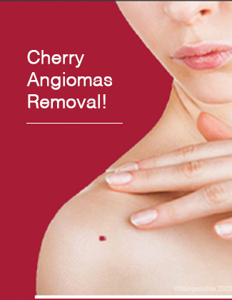 Cherry Angiomas Removal Skinpossible Calgary Laser Clinic