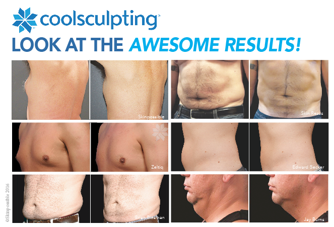 manboobs-calgary coolsculpting Skinpossible