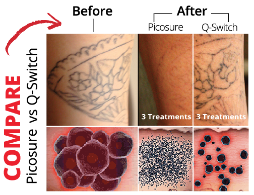 Laser Tattoo Removal and Fading! - Skinpossible Medical Aesthetics Clinic