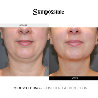 CoolSculpting chin results