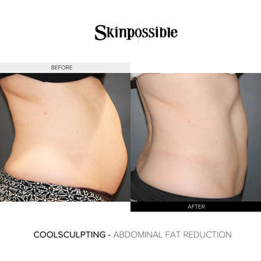 CoolSculpting chin results