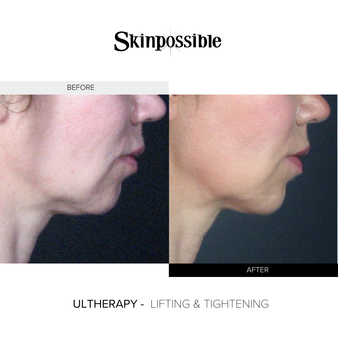 Ultherapy3