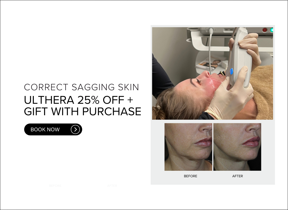 Ultherapy CALGARY promotion25off